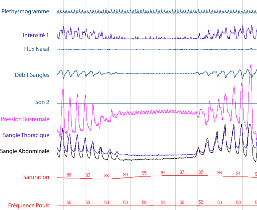 Enregistrement PneaVoX® d’une apnée du sommeil.